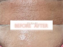 ゆらり/おでこのシワ・肌全体のくすみ