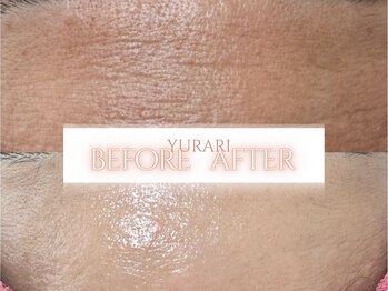 ゆらり/おでこのシワ・肌全体のくすみ