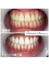 ホワイトニングサロン 京都烏丸店/ホワイトニング施術例
