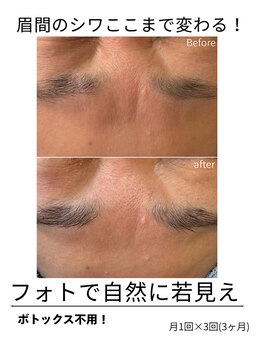 エイチケービューティーサロン(H/K beauty salon)/【眉間のシワにも】