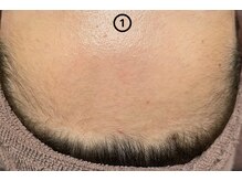 エステサロン桜/【お顔のうぶ毛も・・・】