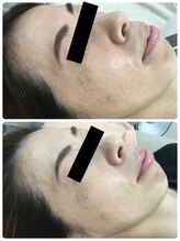 メイユール(MEILLEUR)/光フェイシャル6回