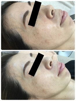 メイユール(MEILLEUR)/光フェイシャル6回