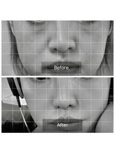 エミルカ(EMILUCA)/ハーブピーリングでお悩み改善