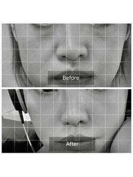 エミルカ(EMILUCA)/ハーブピーリングでお悩み改善