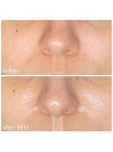 ちらちゅら/クリスティーナ【施術経過】