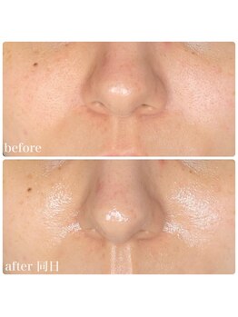 ちらちゅら/クリスティーナ【施術経過】