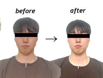 もみの木鍼灸整骨院 恵比寿/初回のみ美容鍼ビフォーアフター