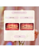 プラスビー 2号店(+b)/ホワイトニングビフォーアフター