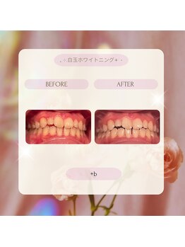 プラスビー 2号店(+b)/ホワイトニングビフォーアフター