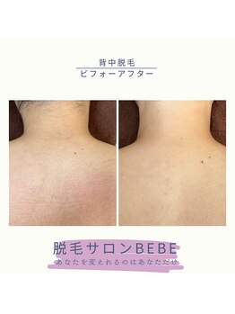 ベベ(Bebe)/背中脱毛♪