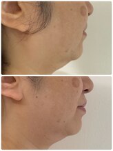 トリートメントルーム フェリーチェ(Felice)/フェイスラインのゆるみ改善