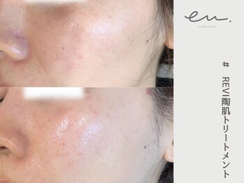 エム(eM.)/REVI陶肌トリートメント1回施術