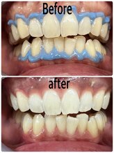 リーラ(LEELA)/ホワイトニング