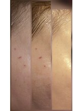 サロン ザ プマロ(SalonThePumalo)/シミケア/くすみ/細かいシミ