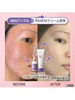 リラクゼーションサロン ラキ(laki)/トロイピール/小顔/赤み/ニキビ