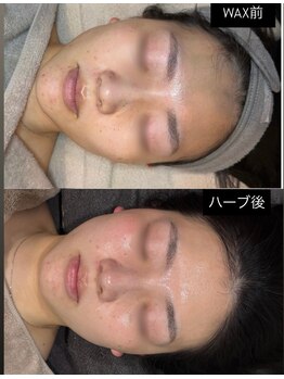 美肌研究所 絹 田辺店/FaceWax+ハーブピーリング