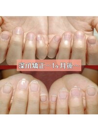 深爪矯正の1ヶ月後、自爪の成長