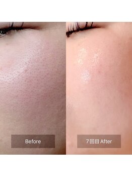 アールカフェドボーテ(R cafe de beaute)の写真/【今話題の水光肌へ】乳酸ピーリング×スピキュール！毛穴・ニキビ・黒ずみを集中ケア