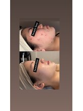 ビューティリュクス(beauty luxe)/頑固なニキビケアに！