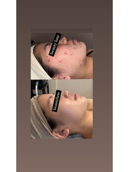 ビューティリュクス(beauty luxe)/頑固なニキビケアに！