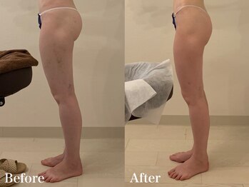 ラヴィエ ベル(La vie est belle)/太腿の前張を薄く！！