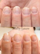 マリーロール 梅田店(Marie Laure)/深爪矯正/自爪育成/自爪風