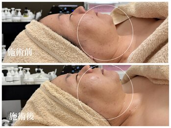 キーオブフェイス(Key of Face)/お悩み【頬のたるみ】