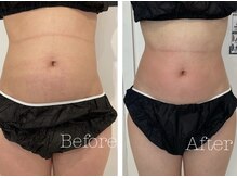 トゥモロー(TOMORROW)/痩せたい部分を集中痩身