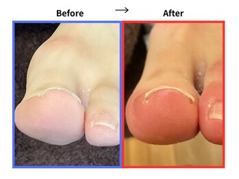 サロンソワ(salon Soi.)/巻き爪ケア