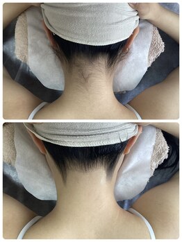 ［脱毛専門・肌育サロン］LULU.tokyo池袋2nd店/うなじ脱毛