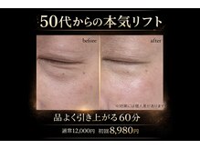 リアンジュ(Liange)/50代たるみビフォーアフター