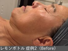 オアシスラグーン(OASIS LAGOON)/レモンボトル（症例2 before）