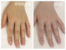 キレイテ 上野店/30代/6回目【ハンドケア上野】