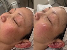 サンオーラ(SUN AURA)/目周りにも◎アプローチ◎