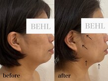 ベール(BEHL)/コルギのBefore After