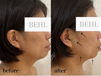 ベール(BEHL)/コルギのBefore After