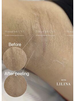 ウィズリリナ 新横浜(with Lilina.)/ローマピンク 症例　途中経過