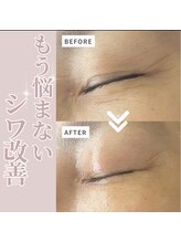 リラクゼーションサロン ラキ(laki)/ハイピールイントゥ/ピーリング