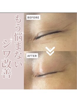 リラクゼーションサロン ラキ(laki)/ハイピールイントゥ/ピーリング