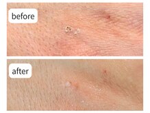 カシェット(Cachette)/30代女性 シミケア5スポット