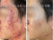 ハナコ 下通店(HANAKO)/【トラブルを繰り返さない肌へ】