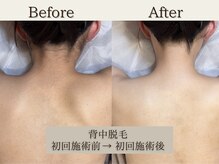 インベスト(INVEST)/背中脱毛