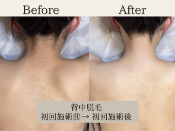 インベスト(INVEST)/背中脱毛