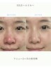【金沢/石川県唯一】韓国肌管理×花粉ひりつき｜赤みレスキューケア¥1,980