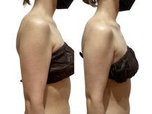 痩せラボ/二の腕の厚みを減らす【痩身】