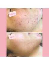 プレジール(Plaisir)/サーマトリックス＆エクソソーム