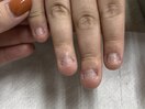 深爪矯正１before　2/4