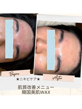 ラヴィン/ニキビケアにもwax