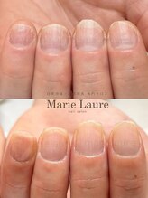 マリーロール 梅田店(Marie Laure)/深爪矯正/自爪育成/自爪風